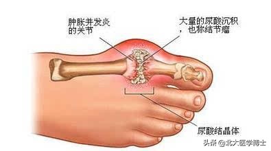 看了医生总结的这五条，尿酸高痛风人就懂得咋让尿酸不高痛风不犯