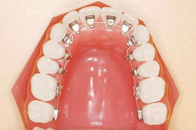 牙齿矫正报价里有多少水分？你被坑了吗？资深牙医给你揭秘（一）