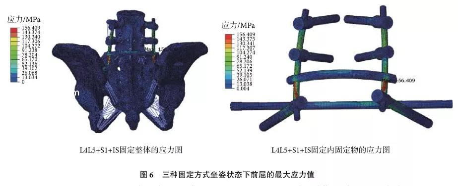 U型骶骨骨折固定的有限元分析