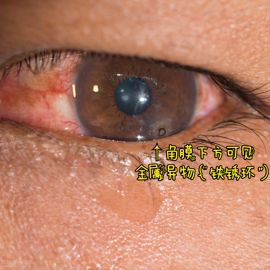 角膜异物是一种什么眼科疾病呢?又该如何处理呢?