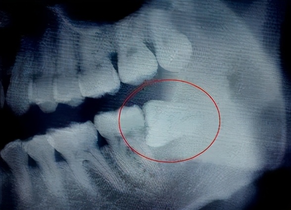 牙齿为什么会长歪?