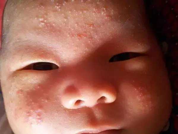 湿疹反复折磨宝宝？婴幼儿70%的湿疹，一招就可以治好！
