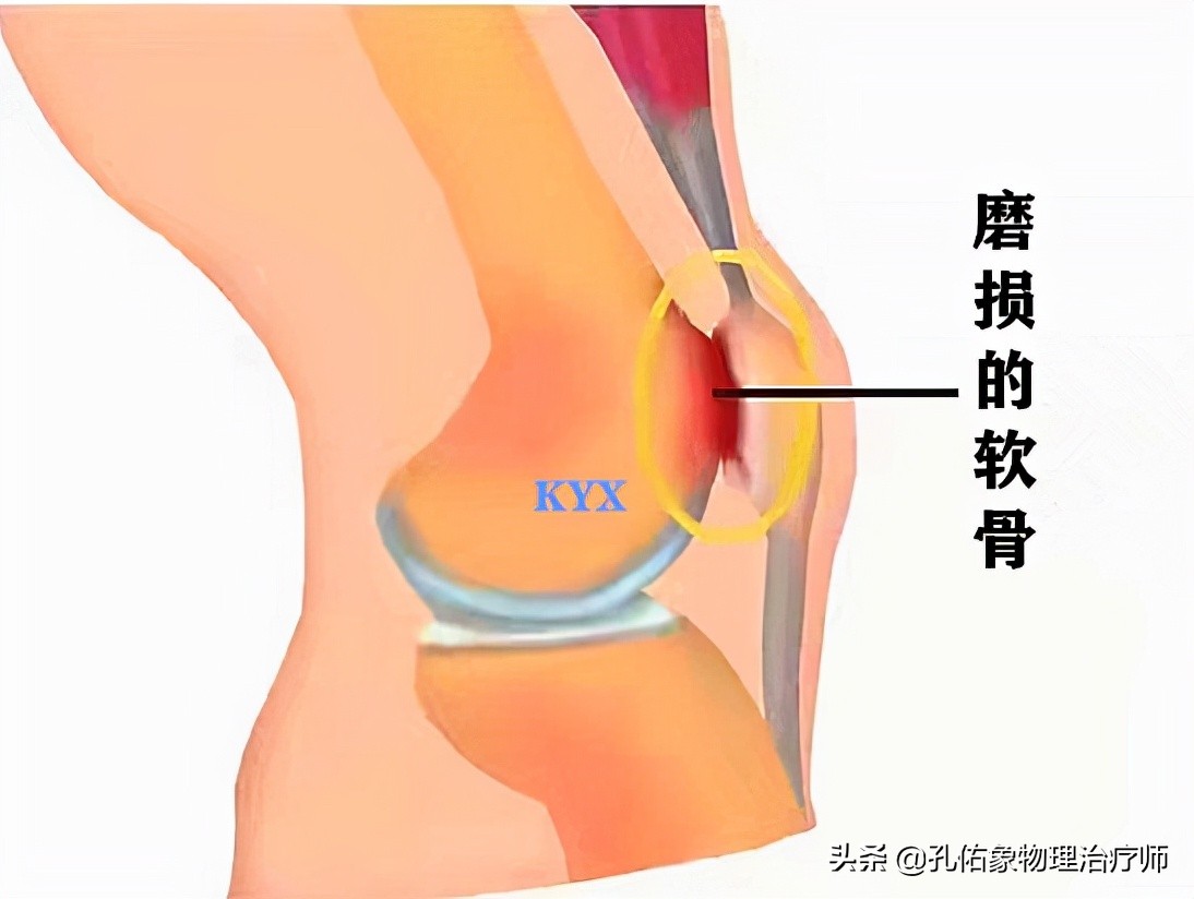 膝关节为什么疼痛？能治好吗？该如何应对呢？给您详细讲清楚