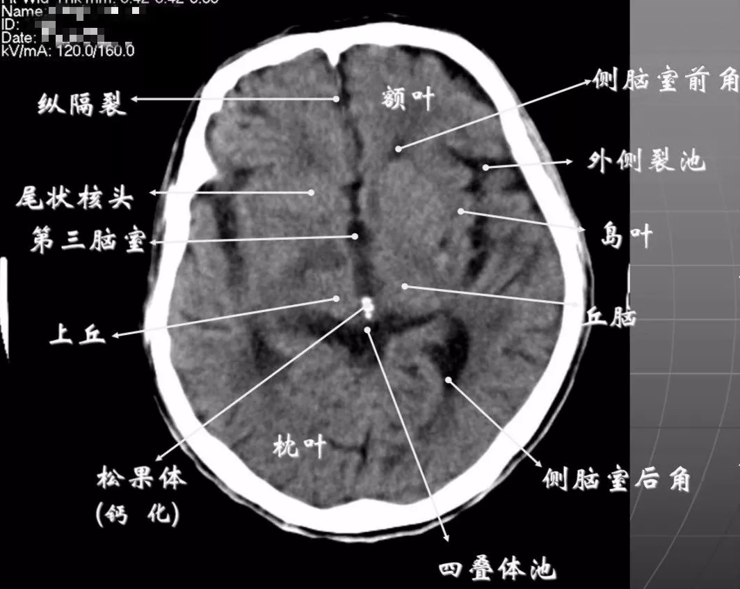 简明又详细的头部CT读片详解，收藏