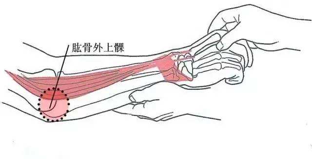 网球肘可以做运动吗(网球肘康复性训练，坚持练绝对有效果)