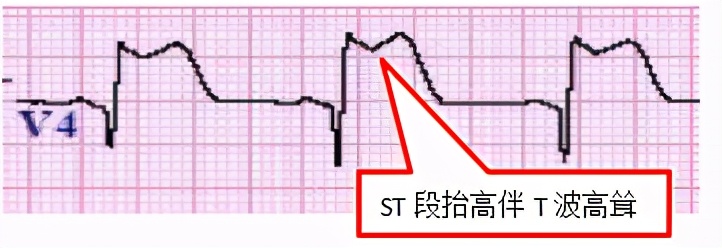 掌握常见心电图，我的心脏我做主