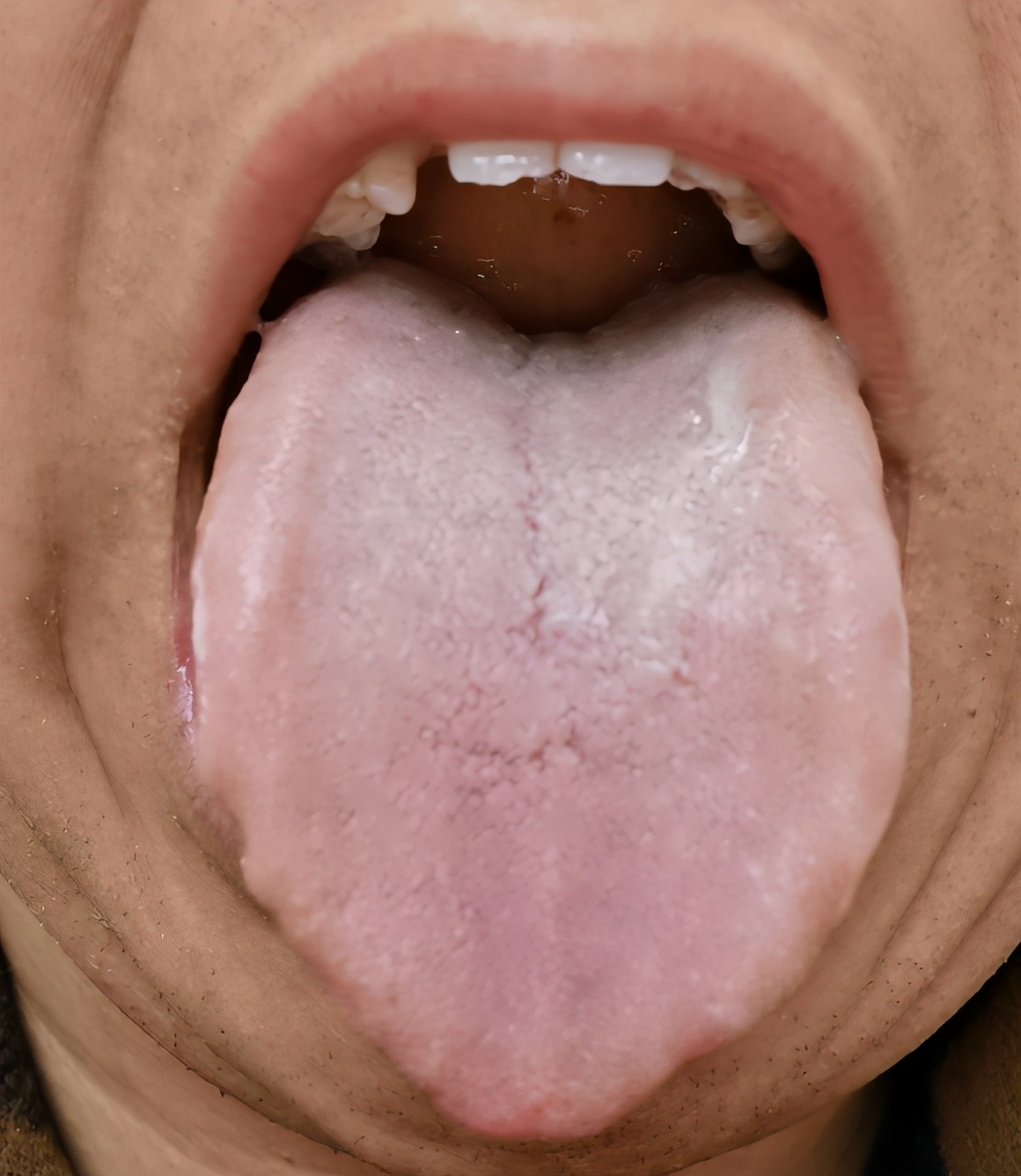 舌头为什么有裂纹?3种原因,3种治法,让裂纹舌有效愈合?