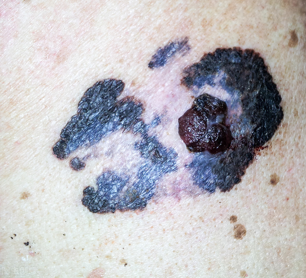 黑色素瘤初期早期图片