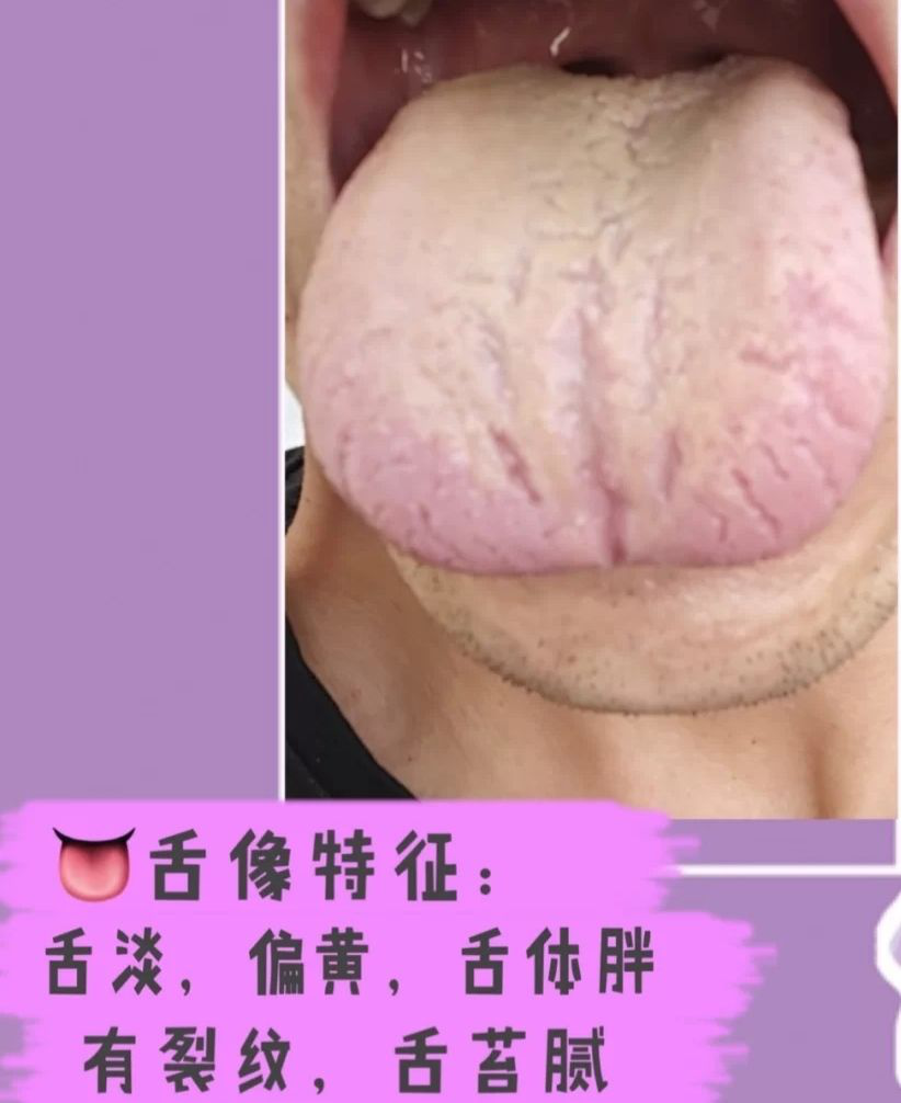 舌头有裂纹是怎么回事？常见的裂纹舌辩证，看看你是哪一种？