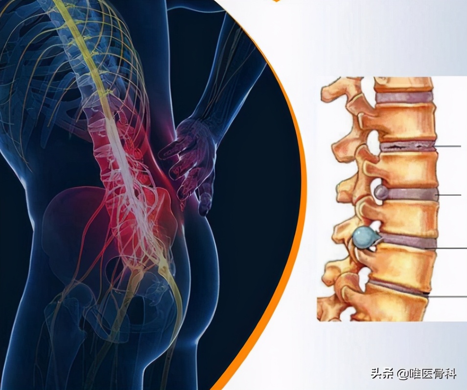 坐骨神经痛是什么引起的(为什么会「坐骨神经痛」?两大原因,一招区分)