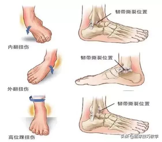 篮球坏了咋修理(「科普」打球崴脚了怎么办？)