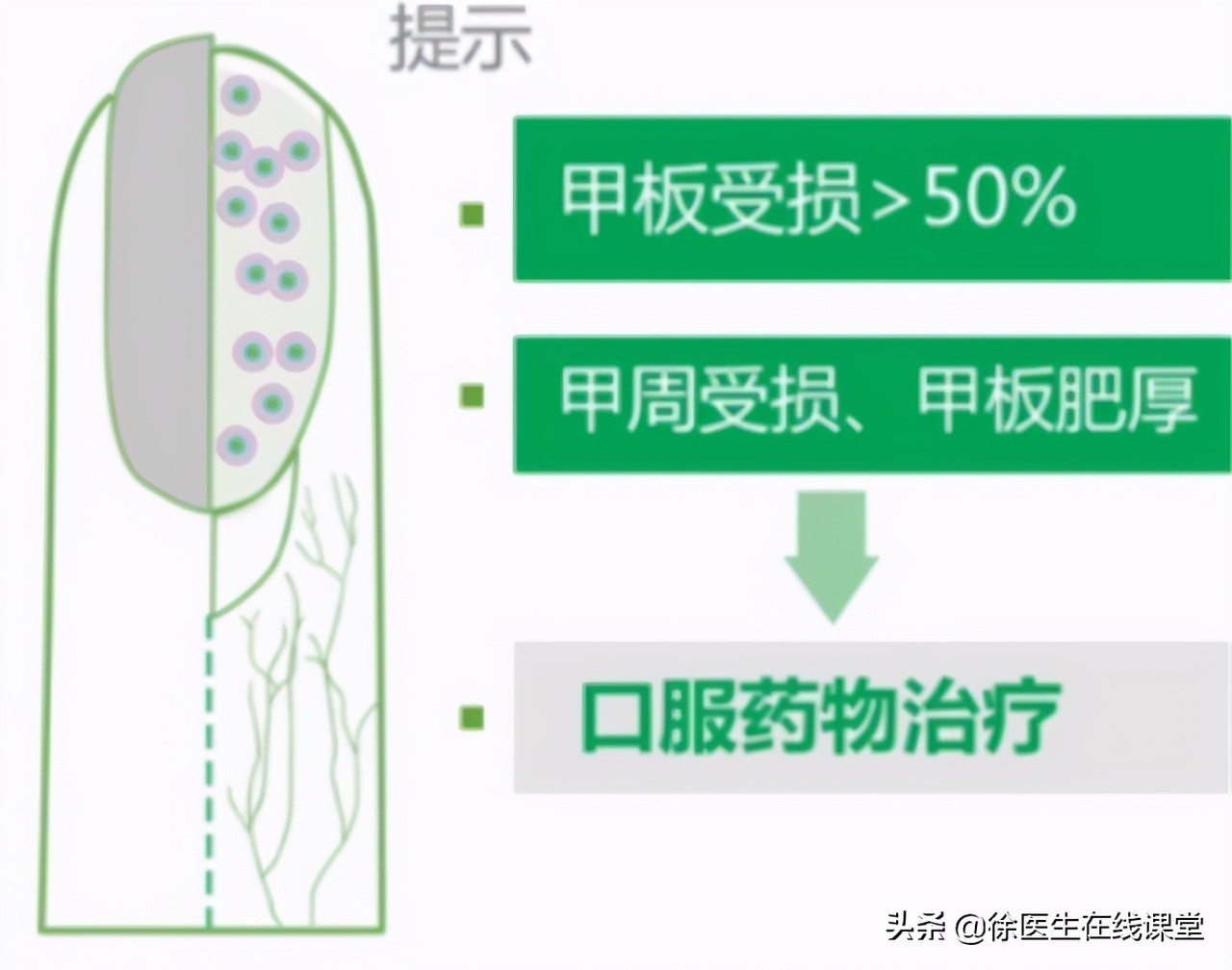 得了灰指甲该怎么治？医生教你三个绝招，帮你治好灰指甲不复发