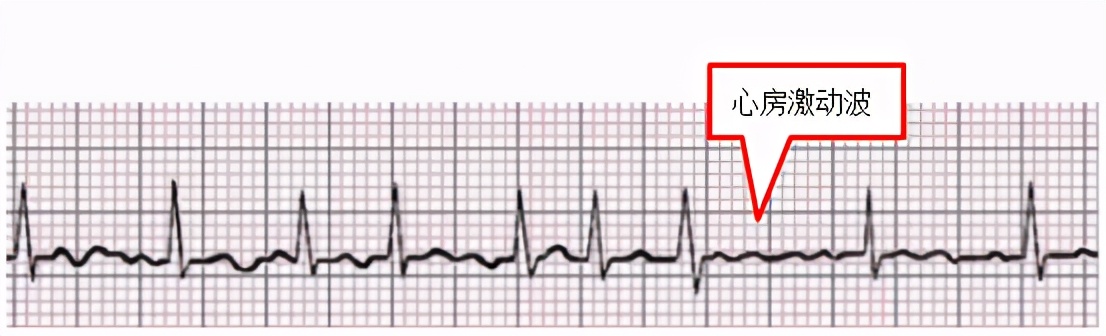 掌握常见心电图，我的心脏我做主