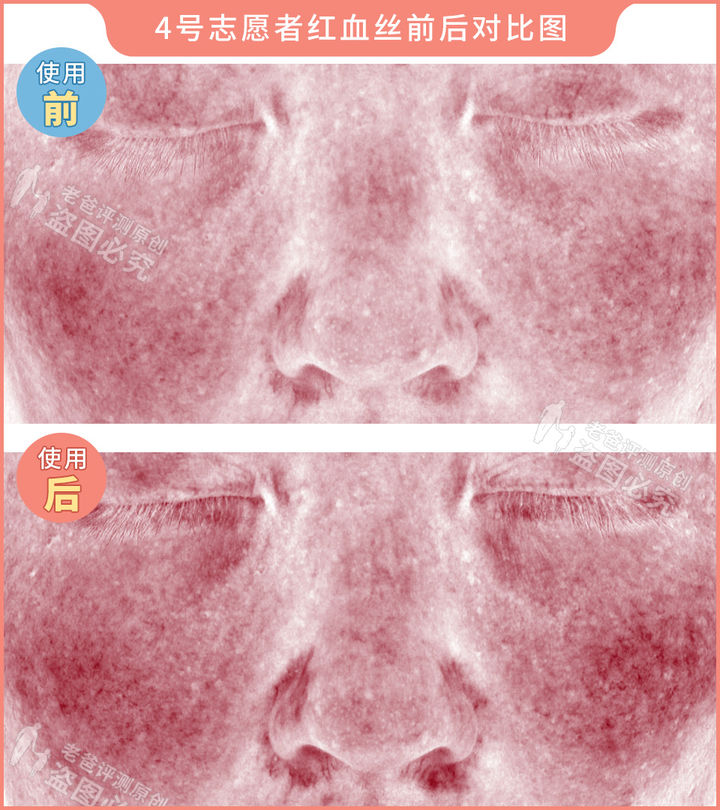 网红家用美容仪真的有效吗？2个多月的跟踪实测结果来了