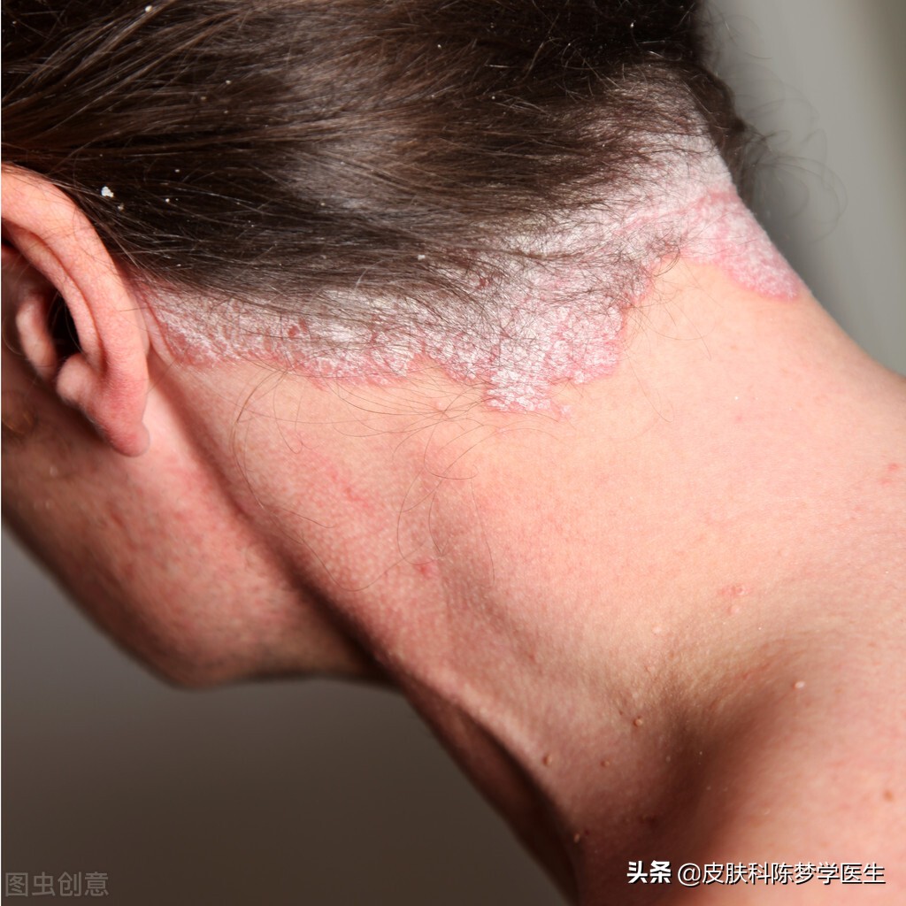 银屑病(牛皮癣)有三大特征,你知道吗?