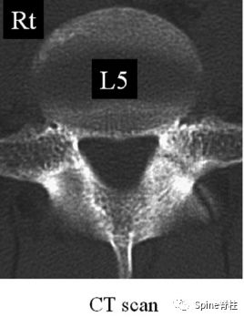 从诊断到治疗：全面解析腰椎峡部裂(lumbar spondylolysis)