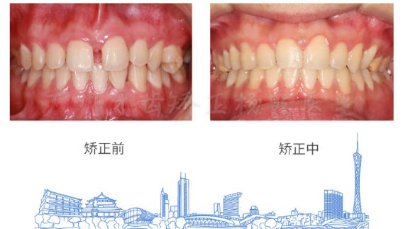 广州牙齿矫正杨露隐适美隐形矫正戴牙套全案例