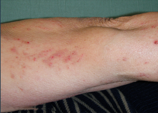 这种前臂背外侧的瘙痒以及疹子常诊断为皮炎湿疹，其实诊断错了