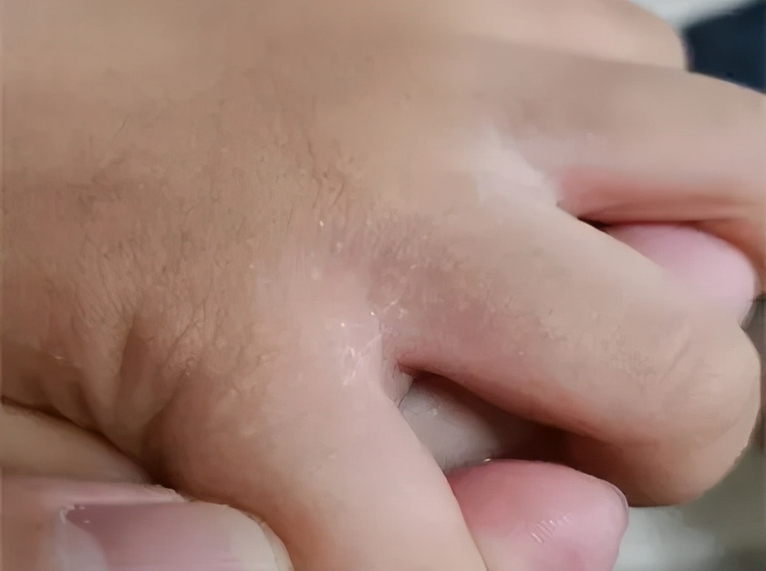 孩子手上起很痒的小疙瘩，是什么？怎么办？