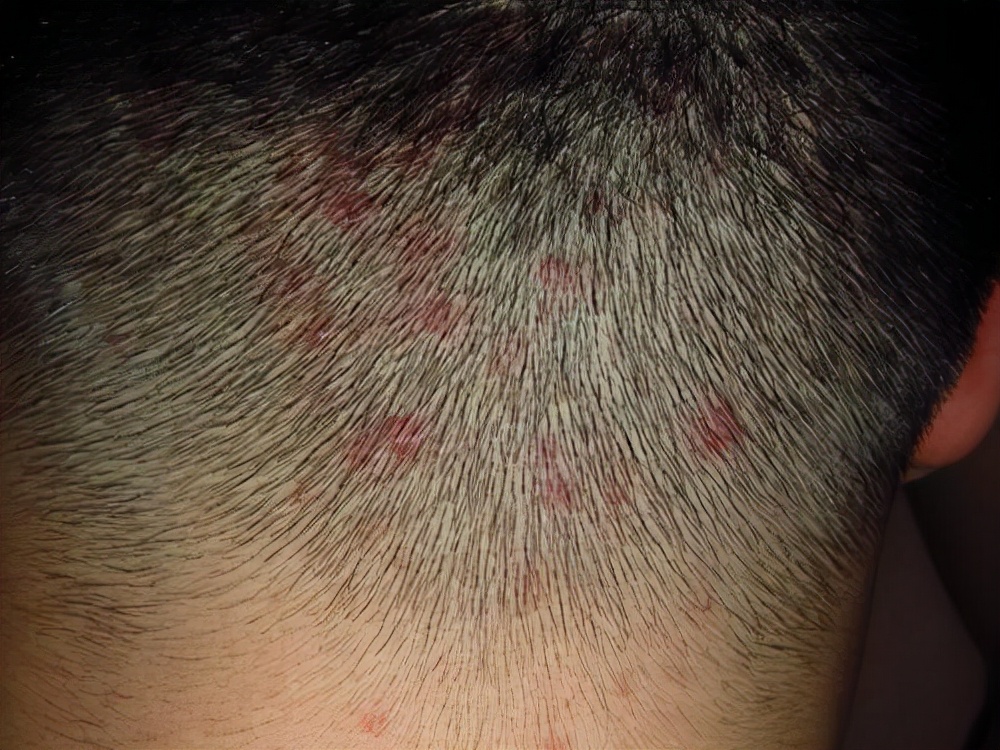 影响健康吗?医生一文解释清楚