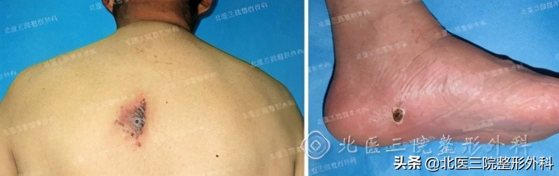 聊一聊：你熟悉的“痦子”