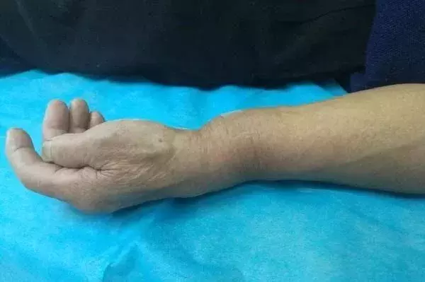 老年人摔倒后手腕骨折了,该怎么办?骨科医生来支招