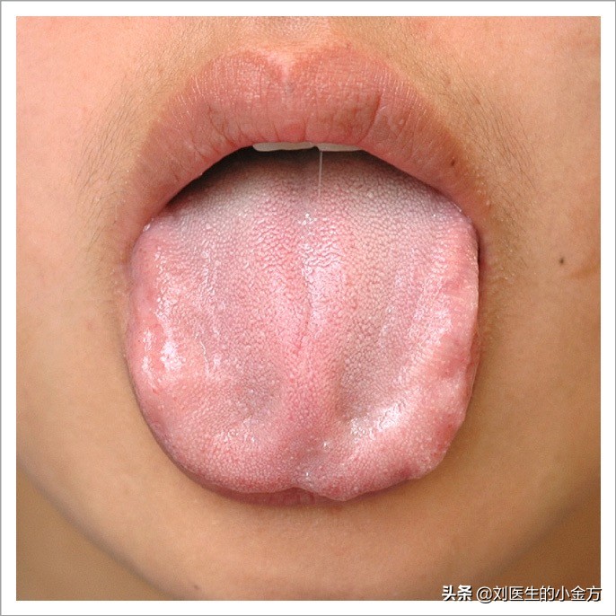 舌苔苔质:光剥无苔,干燥【临床意义】阴虚火旺,或火热灼伤阴液