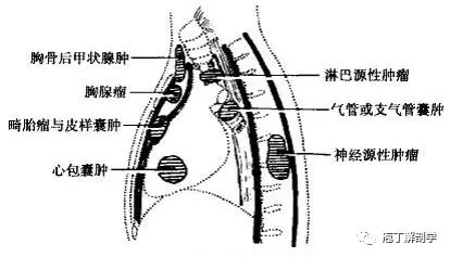 纵隔解剖 + 纵隔疾病X线诊断要点