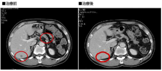 胰腺癌晚期能活多久？当胰腺癌遇上新型疗法，胰腺癌将被“征服”