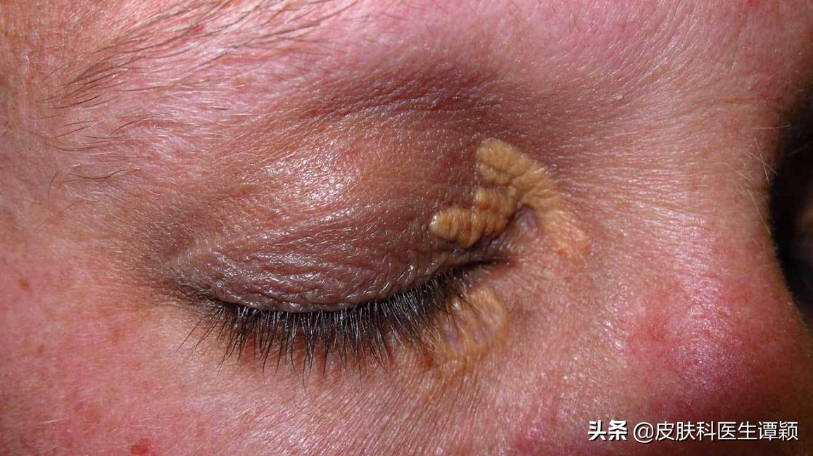 睑黄瘤好发部位是双侧眼睑的周围,尤其是以双侧上眼睑内眦最常见,虽然