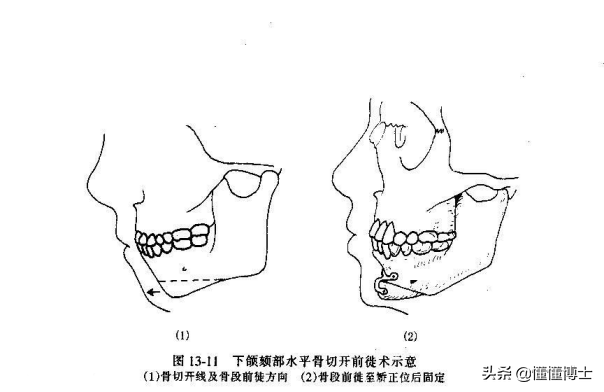 下巴后缩能带给你多大的颜值bug？下巴短和下巴后缩可不一样