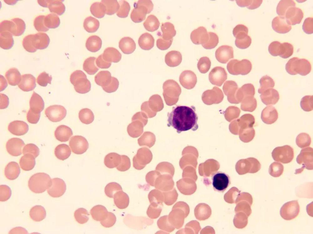 单核细胞升高说明什么问题,单核细胞升高临床意义