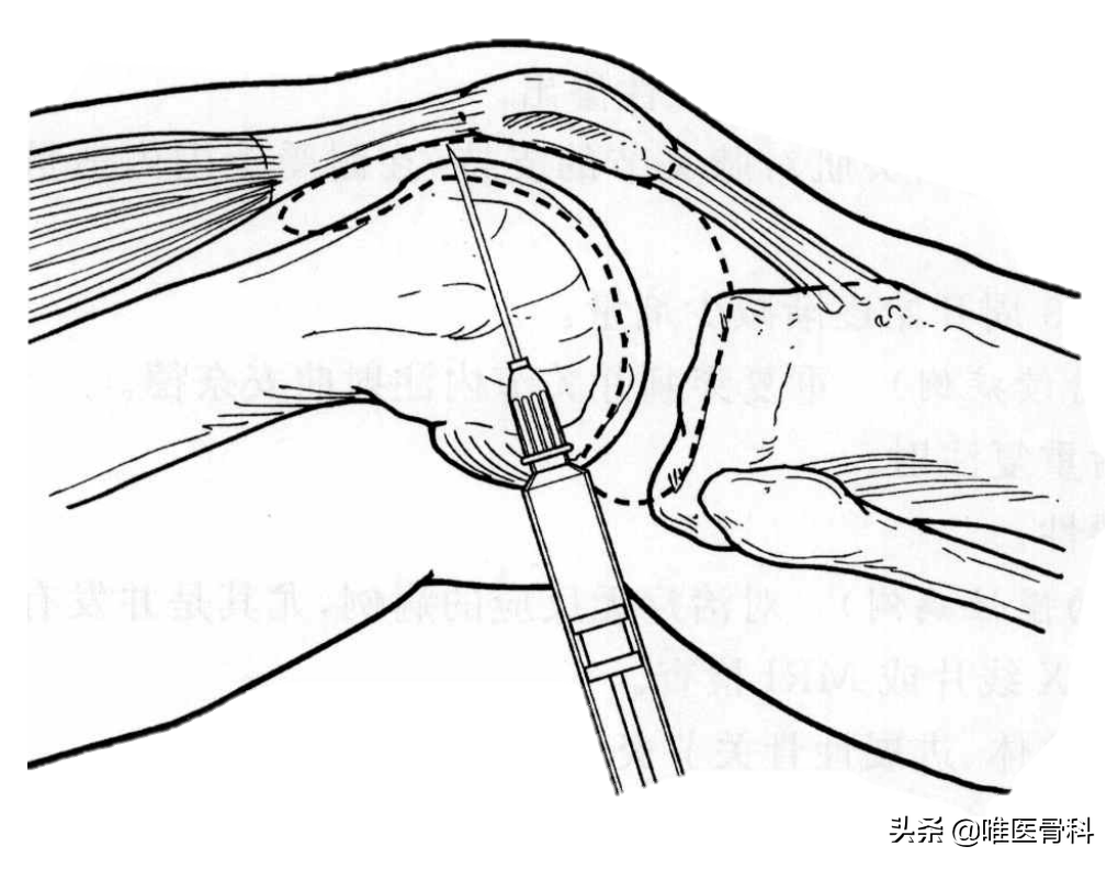 关节炎打玻璃酸钠作为“润滑针”，到底有没有用？