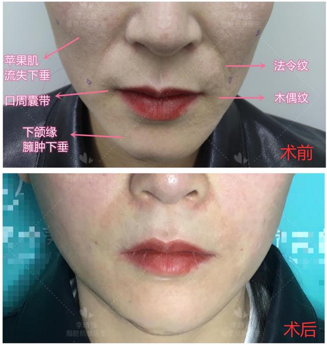 女生遇上面部凹陷，不仅是显老的问题！整形医生教你怎么正确应对