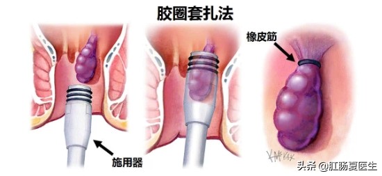 现在的年轻人越来越"野"，竟然自己动手"割"痔疮