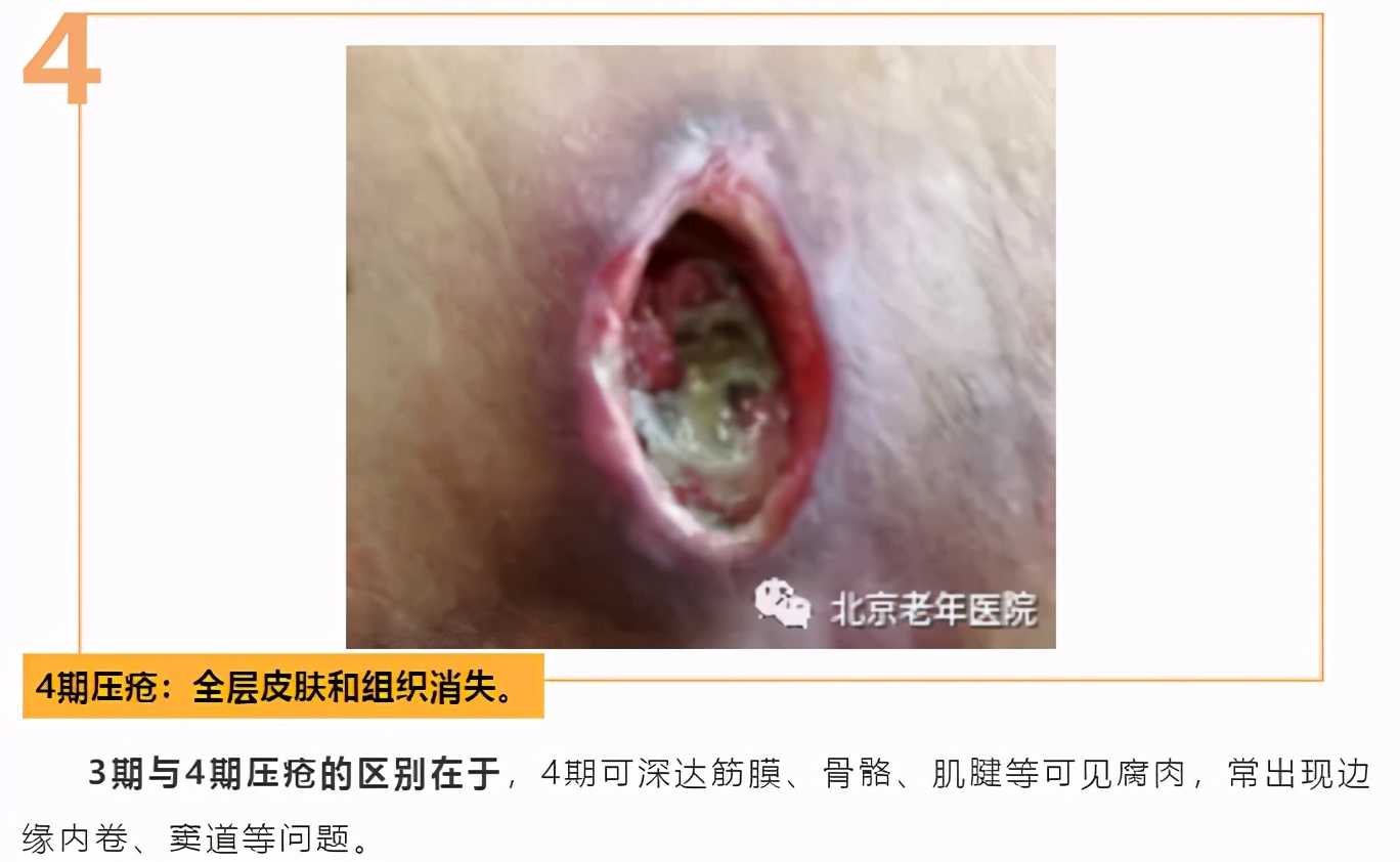 居家照护者如何识别早期压疮？