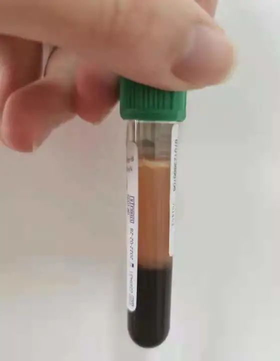 2个月减20斤，可惜这“减肥”药要吃一辈子