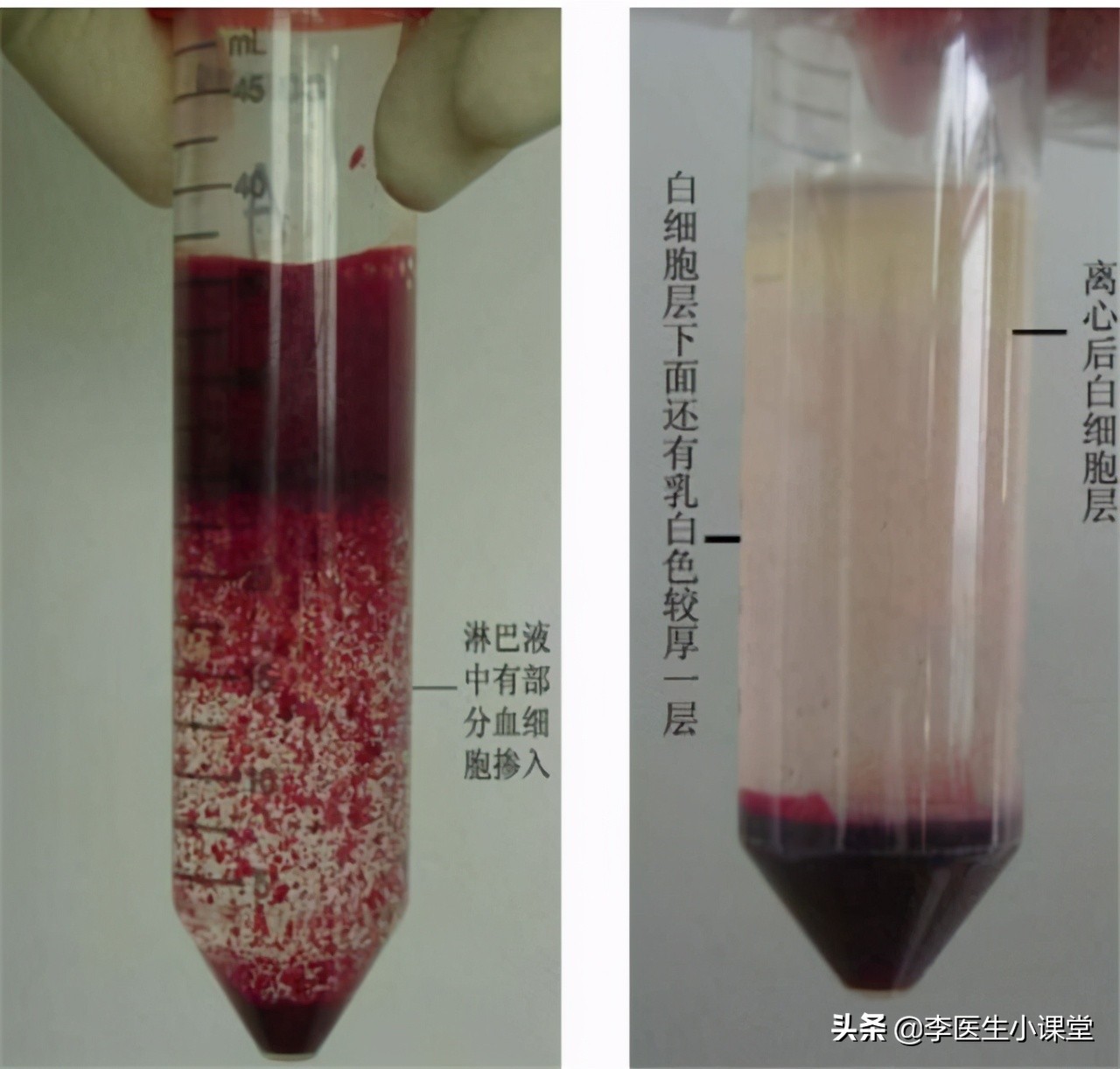 腋下淋巴结肿大(正常人的腋下淋巴图片)