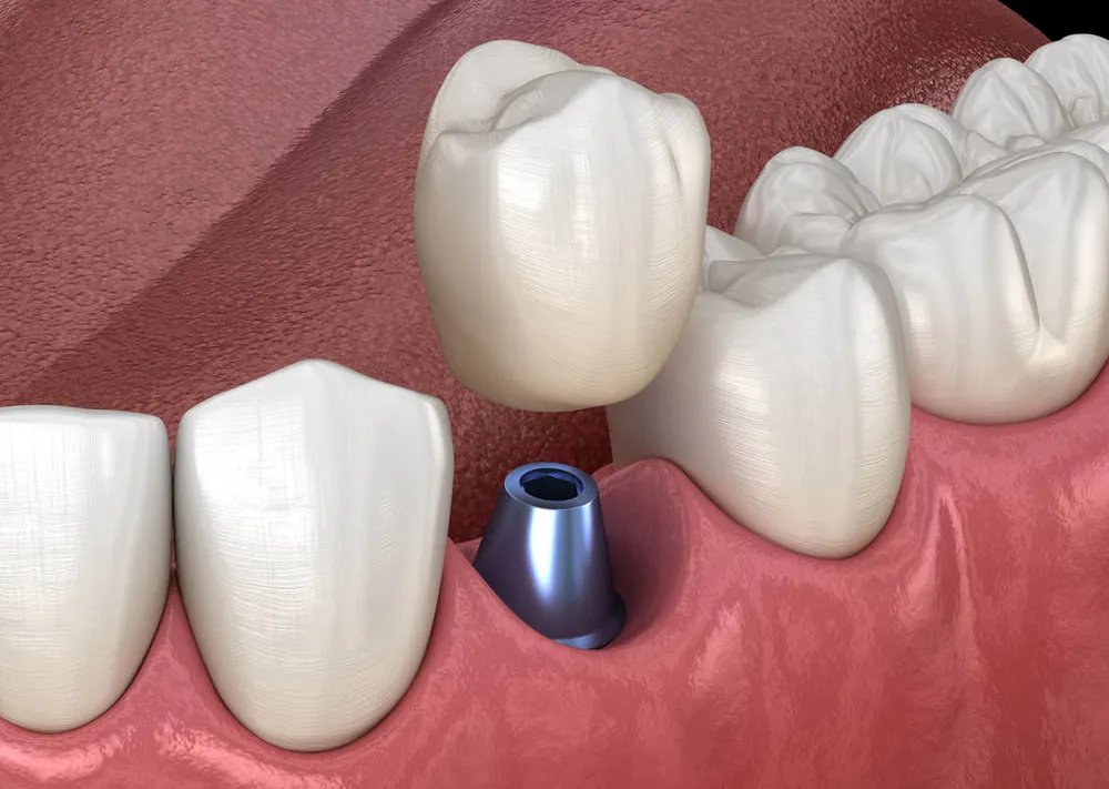 10个人9个有口腔问题，测一测你的“蛀牙、掉牙风险”有多少？