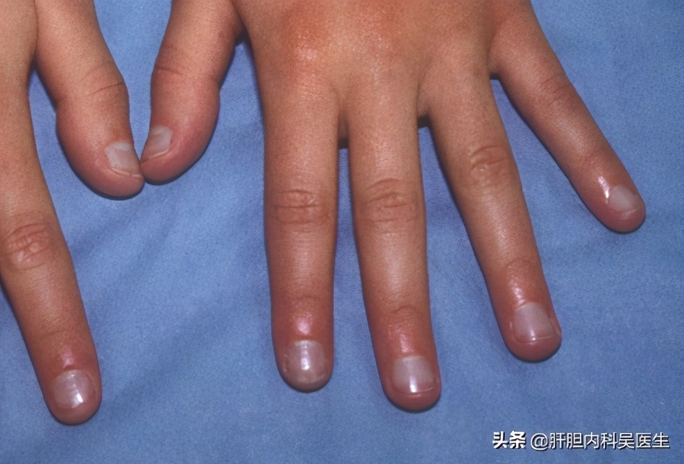 指甲与身体疾病（上）