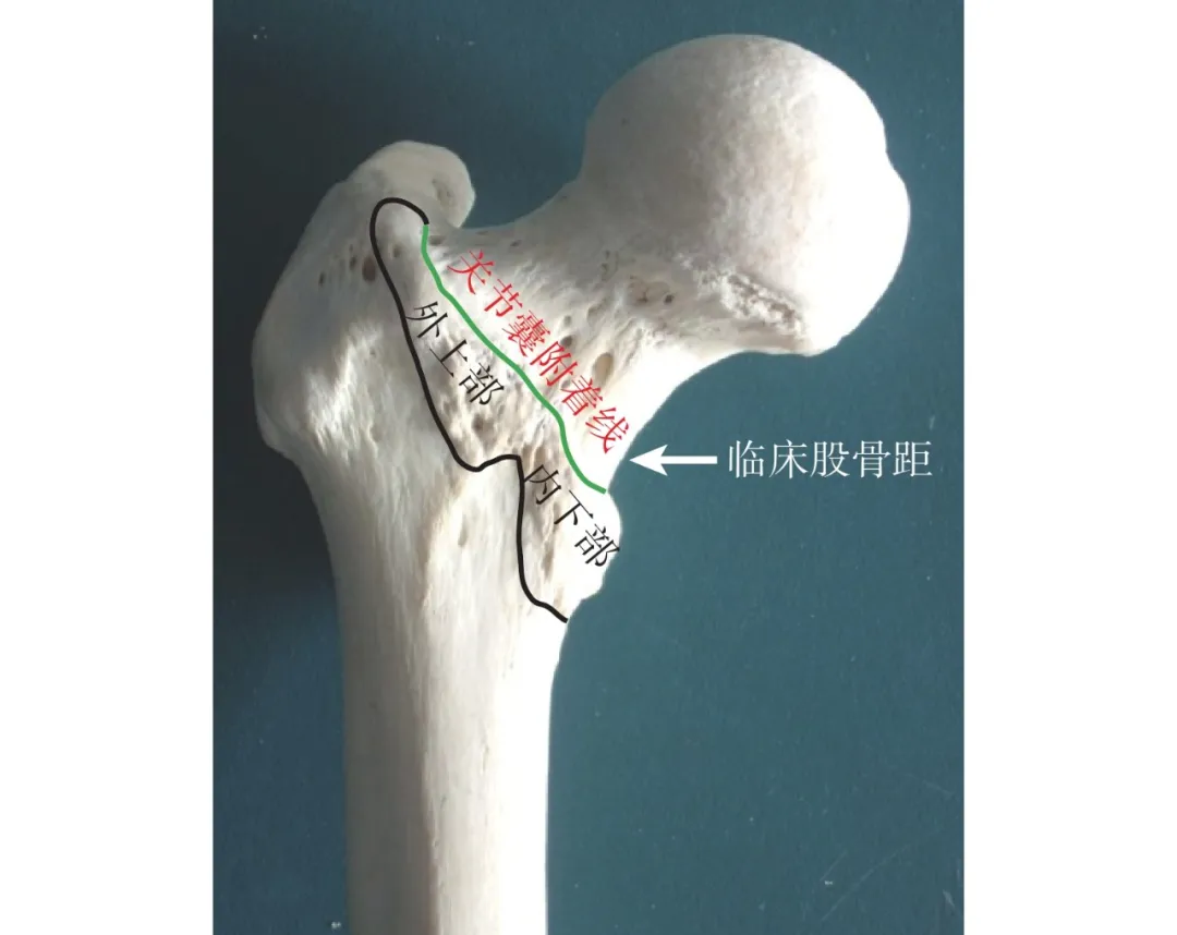 同时累及同侧股骨颈与转子间两个解剖区域的骨折类型与研究进展