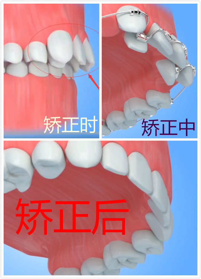 牙齿拥挤不齐，龅牙前突选金属牙套矫正，花钱少时间短性价比高