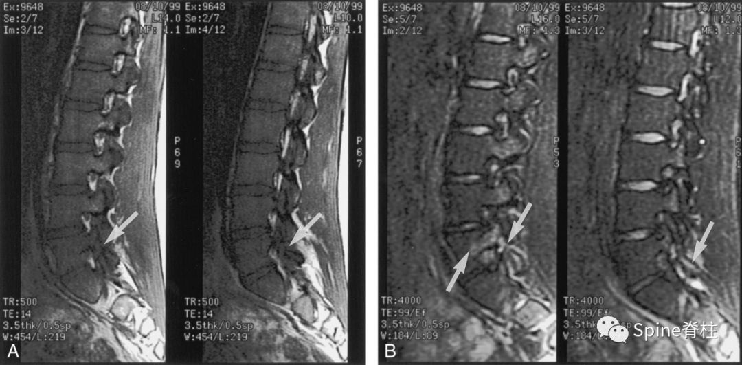 从诊断到治疗：全面解析腰椎峡部裂(lumbar spondylolysis)