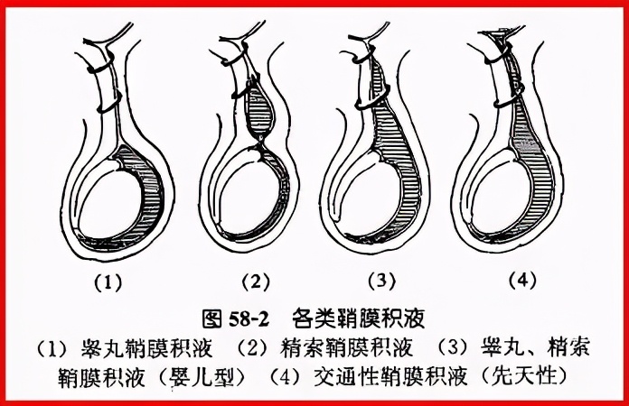 孩子1岁后，这个私处异常情况仍不消失，需及时就医