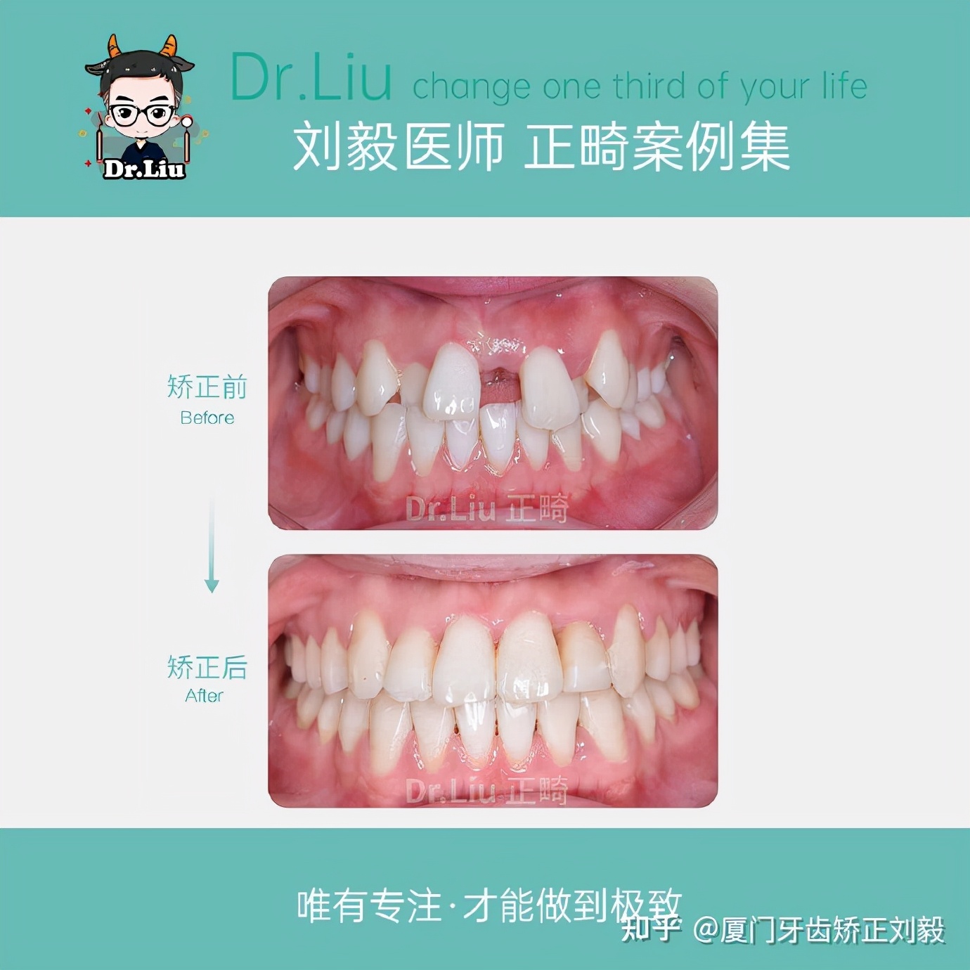 多生牙拔牙多少钱(厦门牙齿矫正)