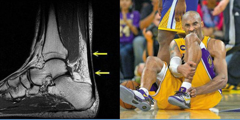 为什么nba球员手压着膝盖(5大伤病足以让球员从巅峰跌落!