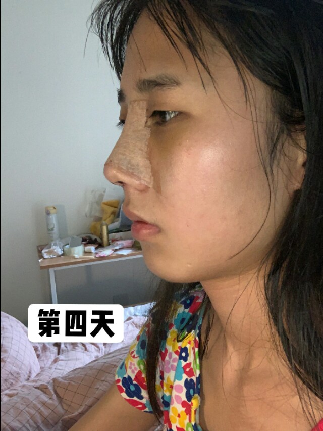 昨晚鼻子后：塌鼻子太丑了!