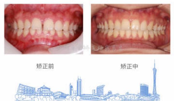 广州牙齿矫正杨露隐适美隐形矫正戴牙套全案例