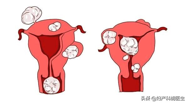 女性巴氏腺囊肿位置图片