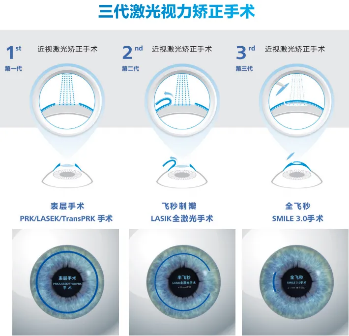 30年前做近视激光手术的人，现在后悔了吗？看完心里有数了